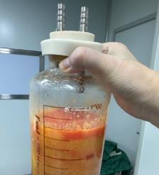 山南水动力吸脂手术要做多久？